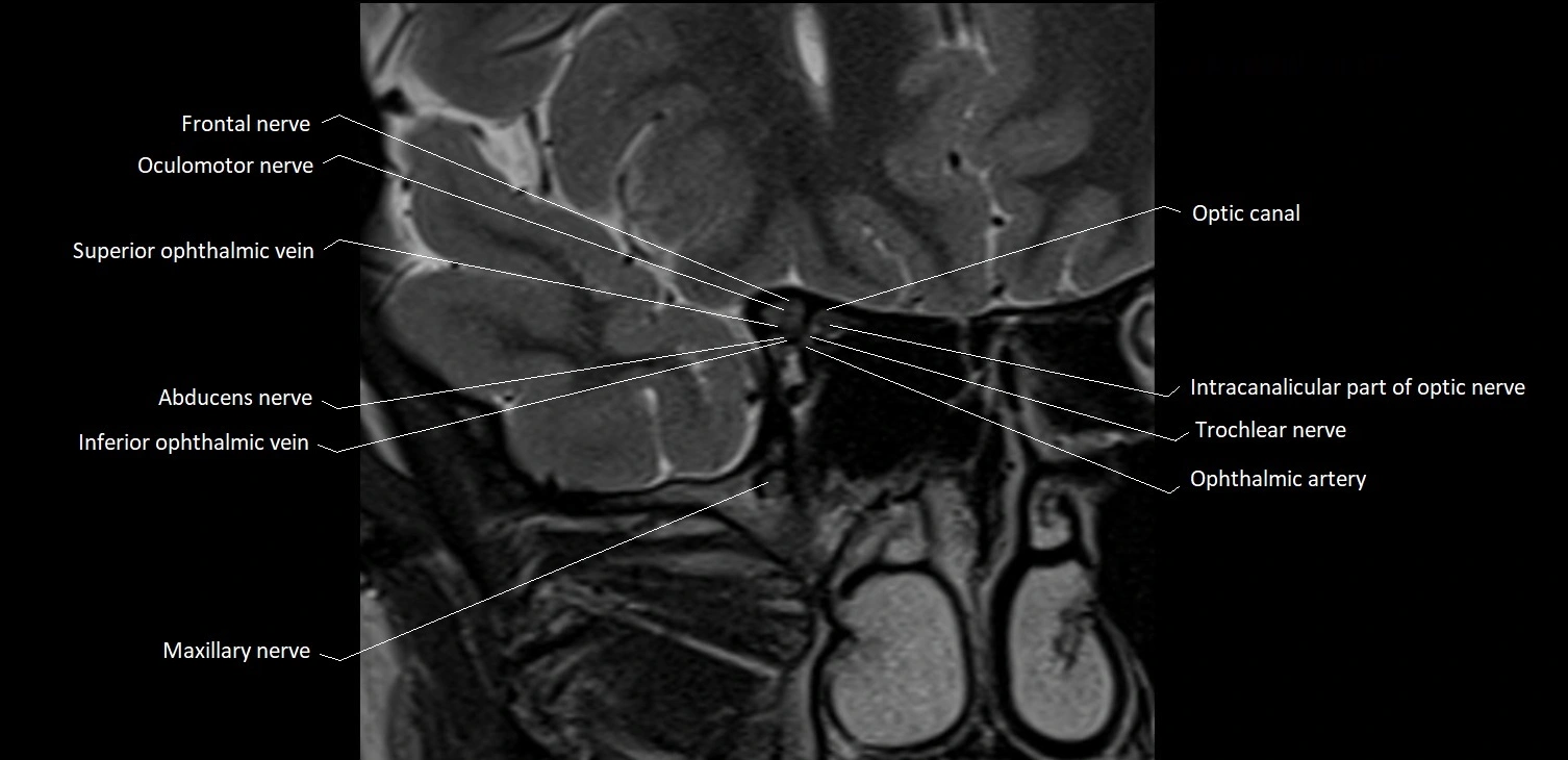 MRI Orbit coronal cross sectional anatomy image 16.webp
